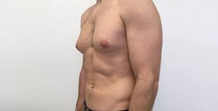 Gynecomastia Surgery