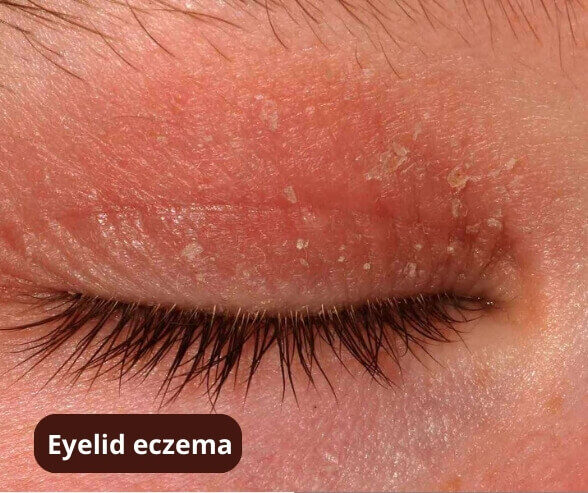 eyelid dermatitis