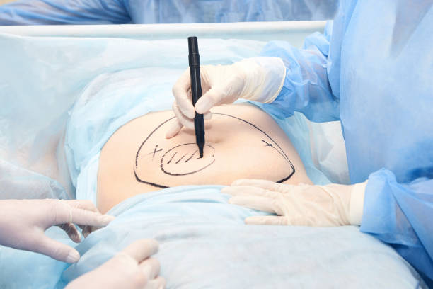 Liposuction surgery in Dubai