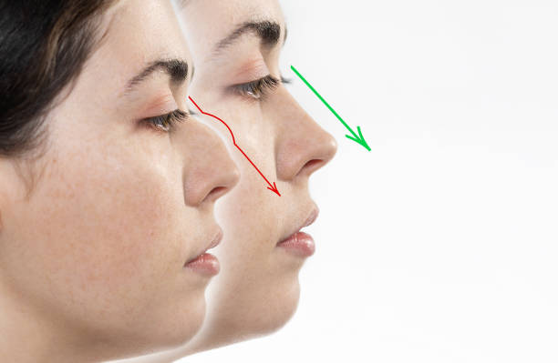 Rhinoplasty in Riyadh